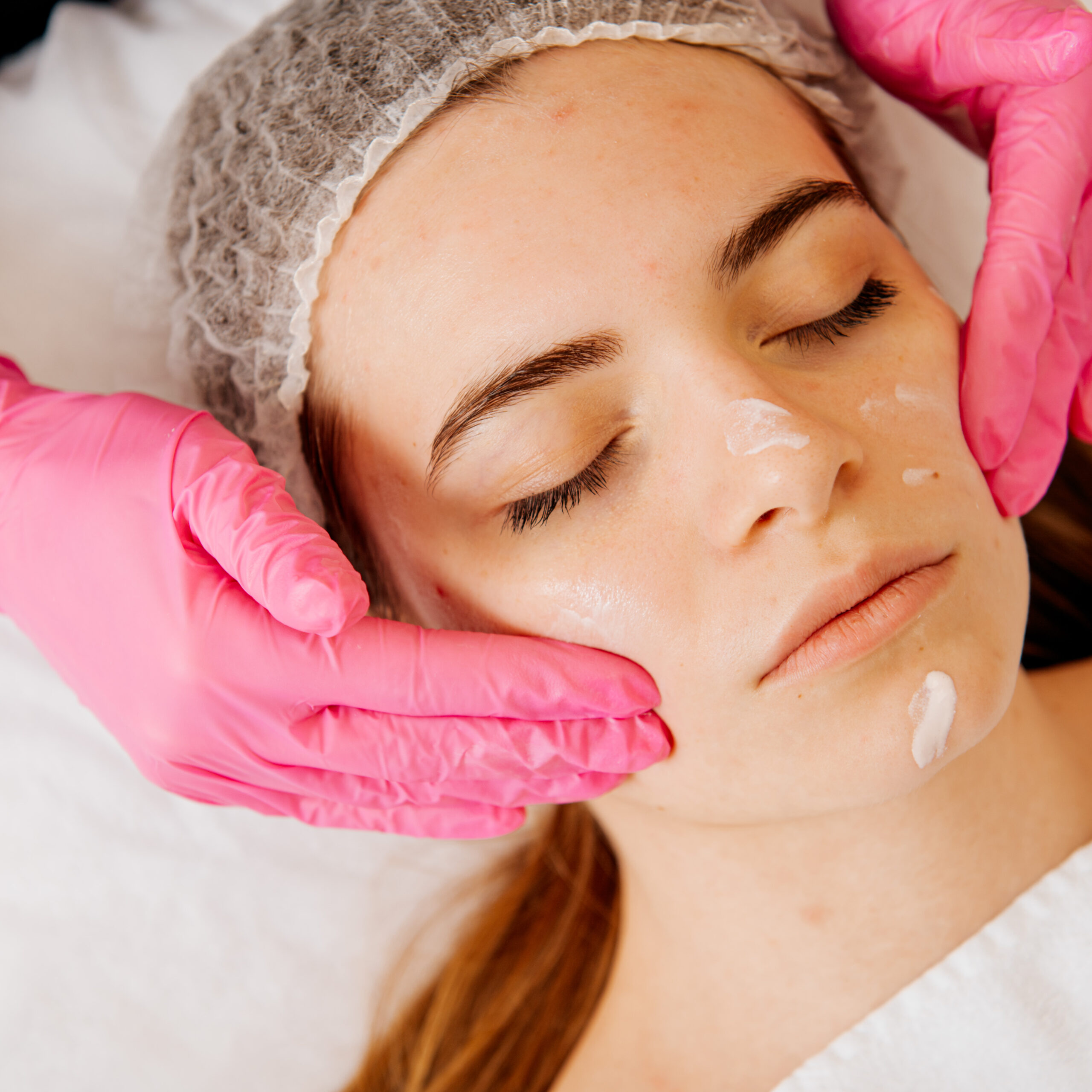 Terapie przeciwtrądzikowe